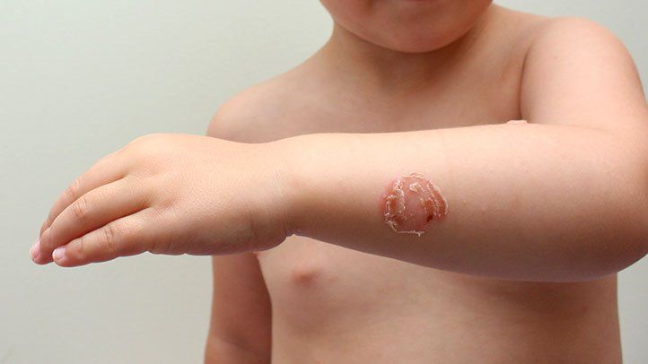 Impetigo rash: yellowish crusts and redness around the mouth and nose