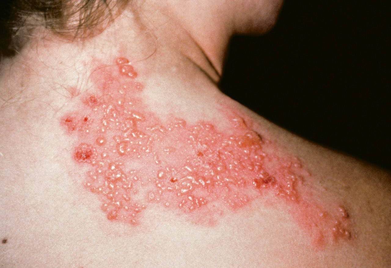 Erupção de herpes zóster: faixa de bolhas com vermelhidão num dos lados do corpo