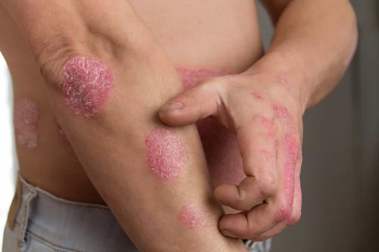 Psoriasis on the elbow: sharply bordered red patches covered with silvery scale